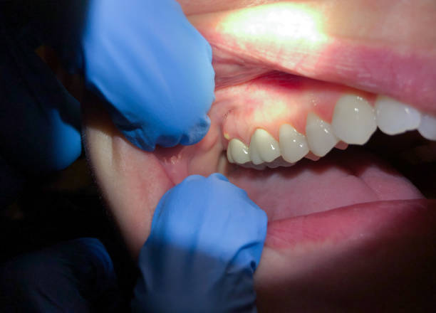 Best Emergency Treatment for Oral Infections in , NC
